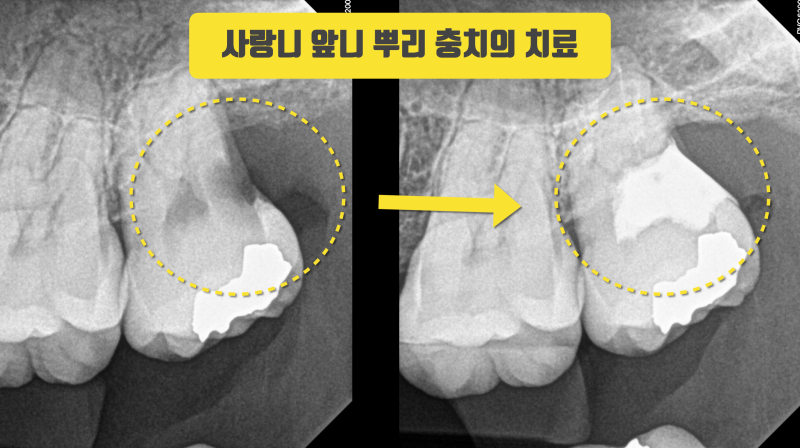 사랑니 앞니 뿌리가 썩었을 때 치아 살리기 #치아재식술 #의도적재식술