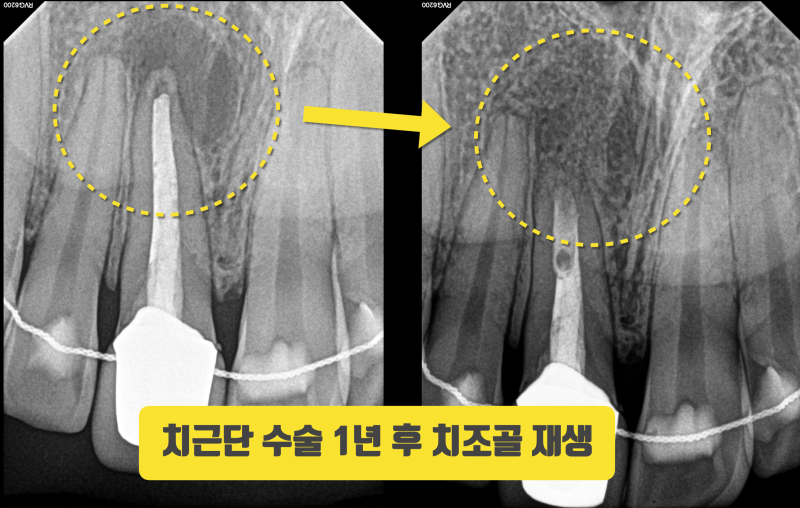 치근단 수술로 치아 살리기 1년 증례 치조골 재생 #치근단수술 #치근절제술