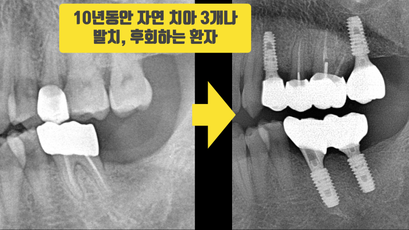 10년의 후회, 본인 스스로 치아 망가트린 사례 #치아재식술 #의도적재식술 #재식술