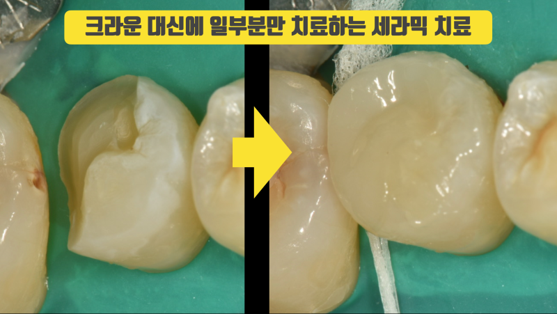 치아를 적게 깍는게 더 좋고 더 어렵습니다, 치과 세라믹(이맥스)