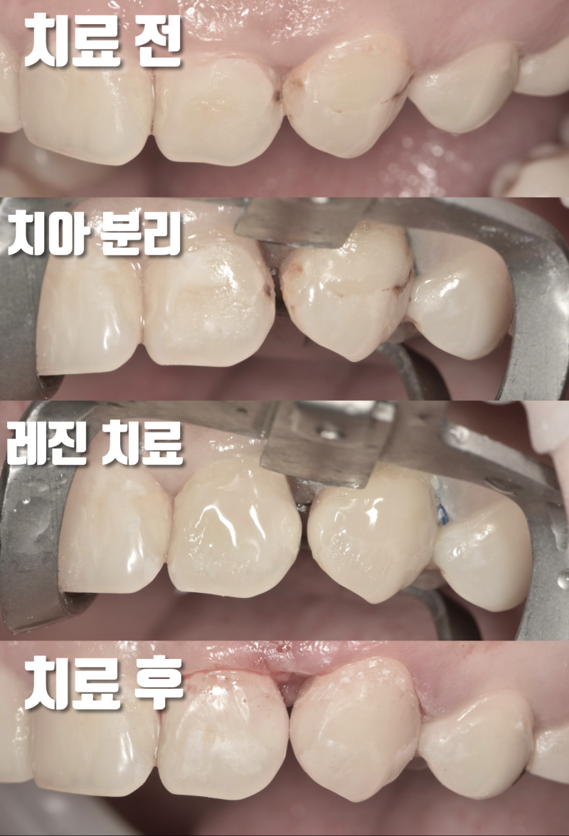 까다로운 앞니 충치 레진 치료 #앞니레진 #치아살리기