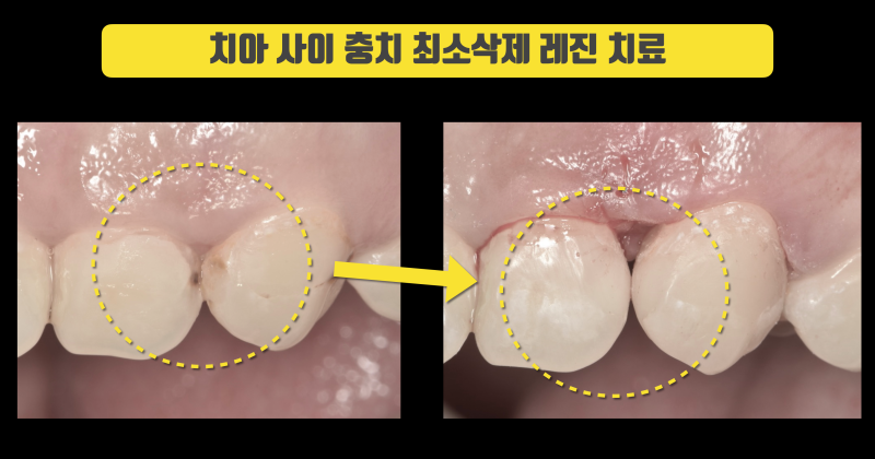 까다로운 앞니 충치 레진 치료 #앞니레진 #치아살리기