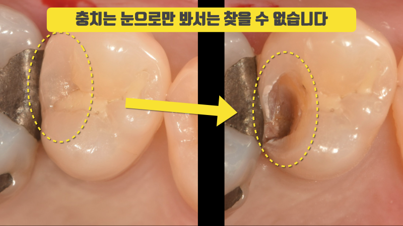충치는 눈으로 찾는게 아닙니다 3단계를 거쳐야 합니다 사진 3