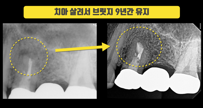 브릿지 뜯지 않고 9년간 잘 쓰는 환자 #치근단수술 #치아살리기