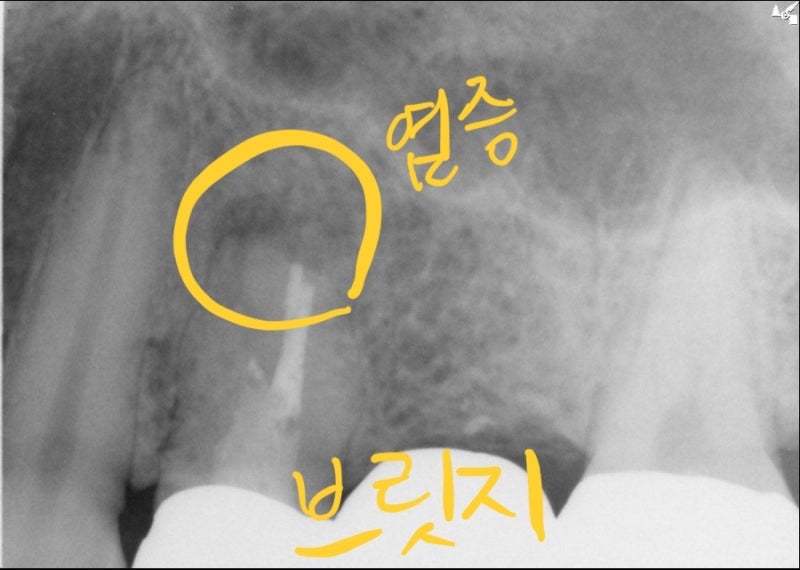 브릿지 뜯지 않고 9년간 잘 쓰는 환자 #치근단수술 #치아살리기