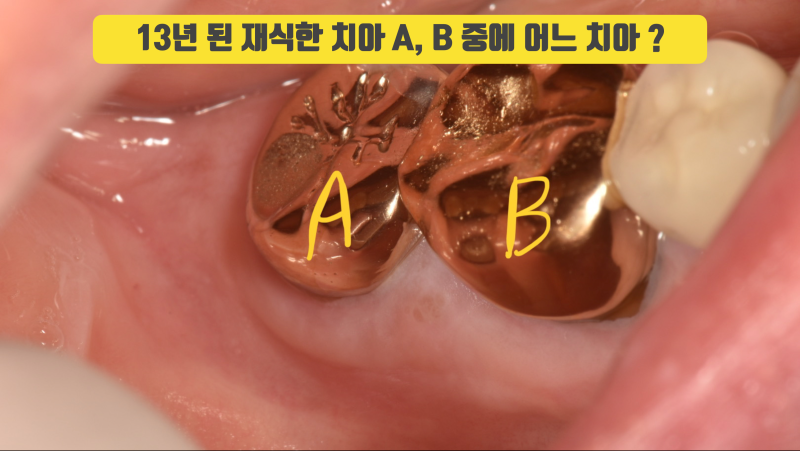 어느 치아가 재식술한 치아일까요 ? #치아재식술 #의도적재식술 #재식술