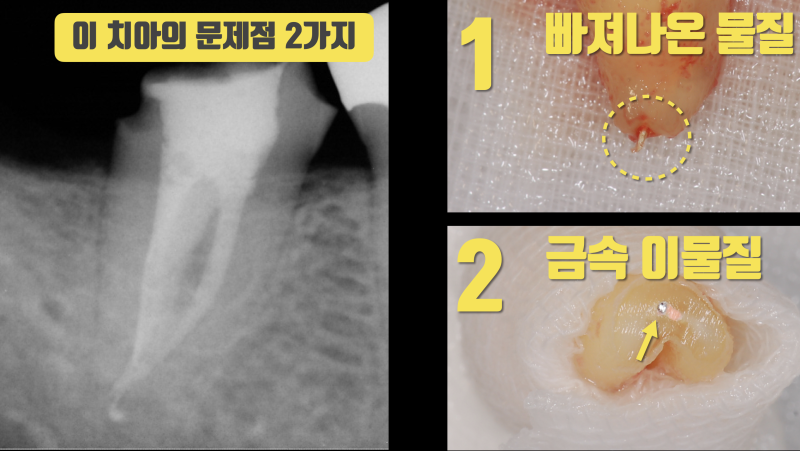 해결 안되는 치아 문제, 직접 봐야 하는 이유 #재식술 #치아살리기