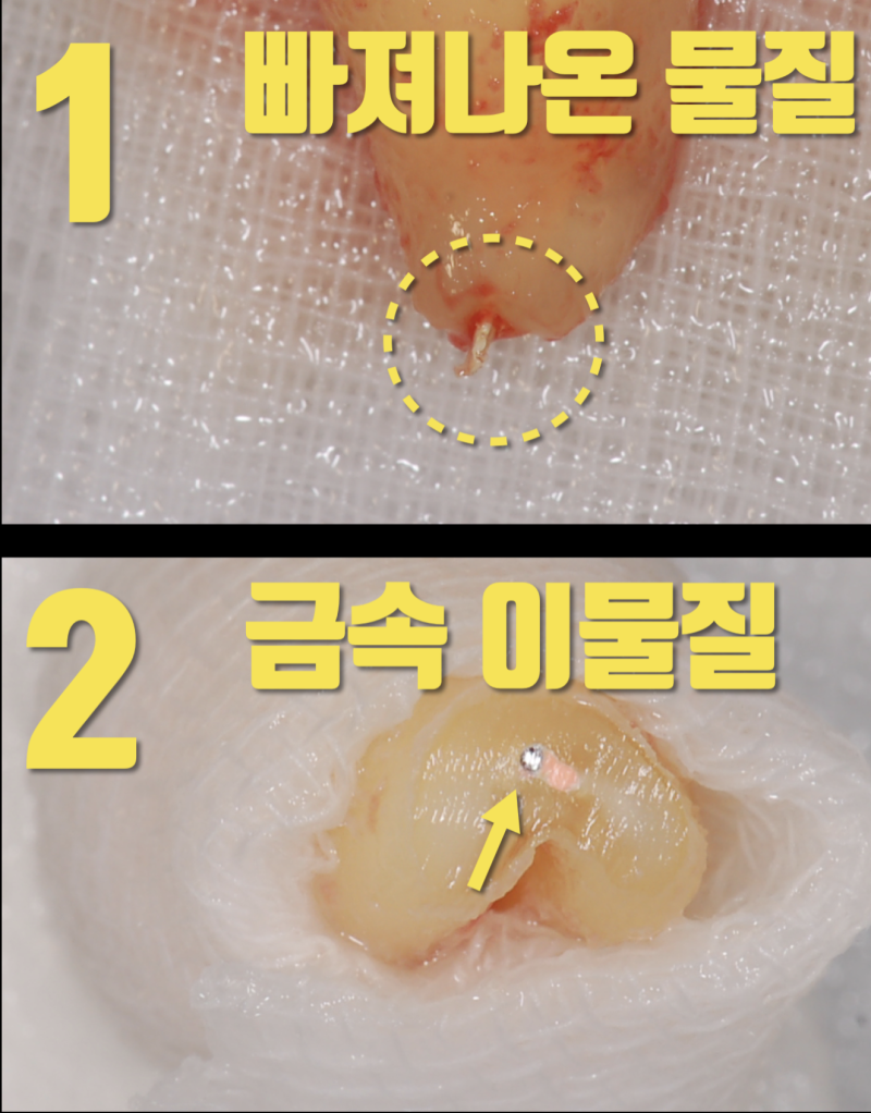 재식술로 치아 살리기 13년 증례 #치아재식술 #의도적재식술 사진 2