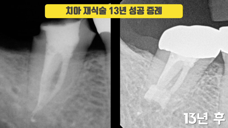 재식술로 치아 살리기 13년 증례 #치아재식술 #의도적재식술