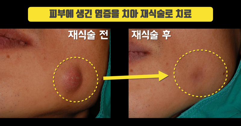 치아 재식술로 피부 염증 해결한 증례 #치아재식술 #의도적재식술