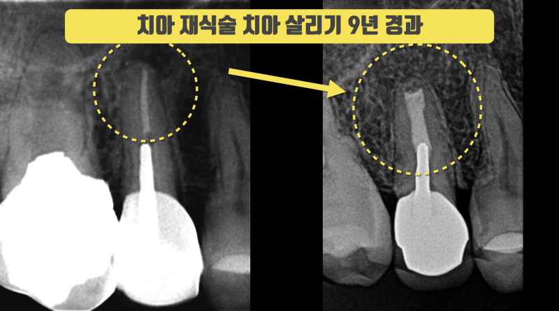 직접 보기 전에는 절대 알수 없는 치아의 문제 해결 : 재식술 9년 경과 치아재식술