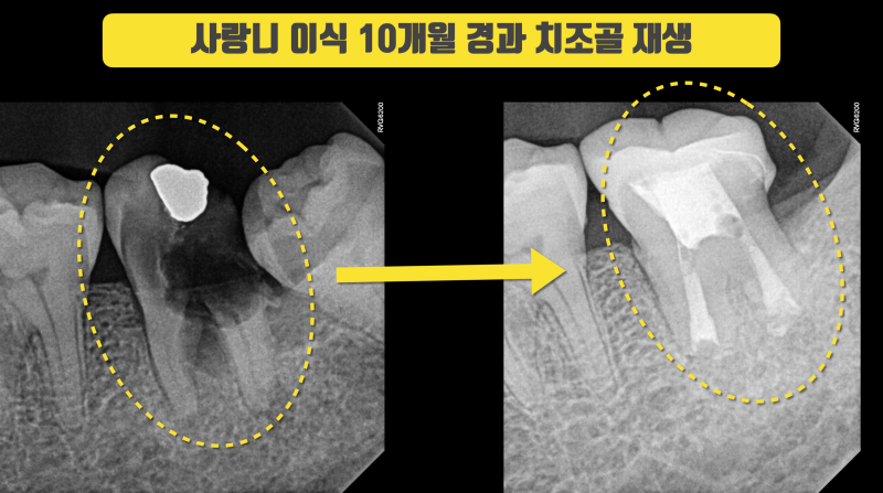 할 수만 있으면 최상의 결과 사랑니 이식 #치아이식 #사랑니이식 사진 2
