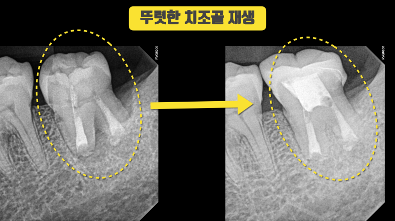 할 수만 있으면 최상의 결과 사랑니 이식 #치아이식 #사랑니이식