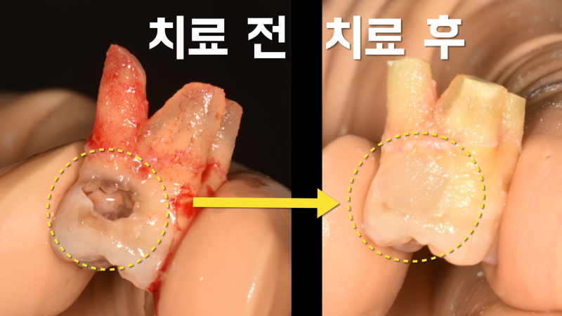 치료하기 어려운 뿌리 충치의 해결 : 치아 재식술 #치아살리기