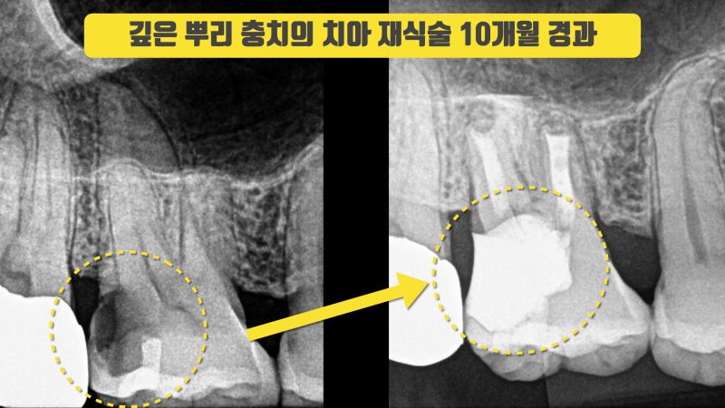 치료하기 어려운 뿌리 충치의 해결 : 치아 재식술 #치아살리기 사진 4
