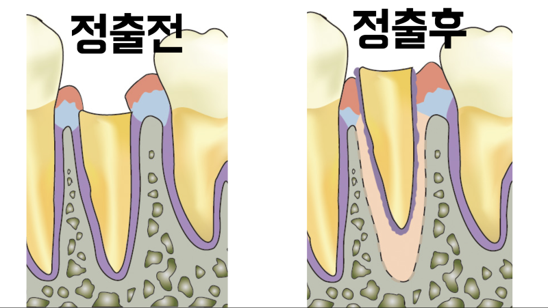 뿌리 망가진 치아 치아재식술로 살린 경우 #치아재식술 #의도적재식술 사진 2