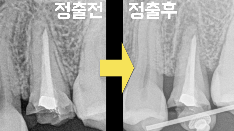 뿌리 망가진 치아 치아재식술로 살린 경우 #치아재식술 #의도적재식술