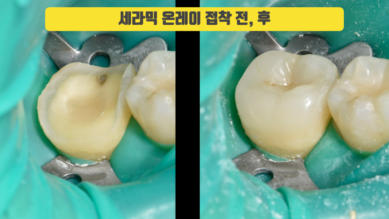 예쁘고 치아를 아끼는 세라믹 치료 #치아살리기
