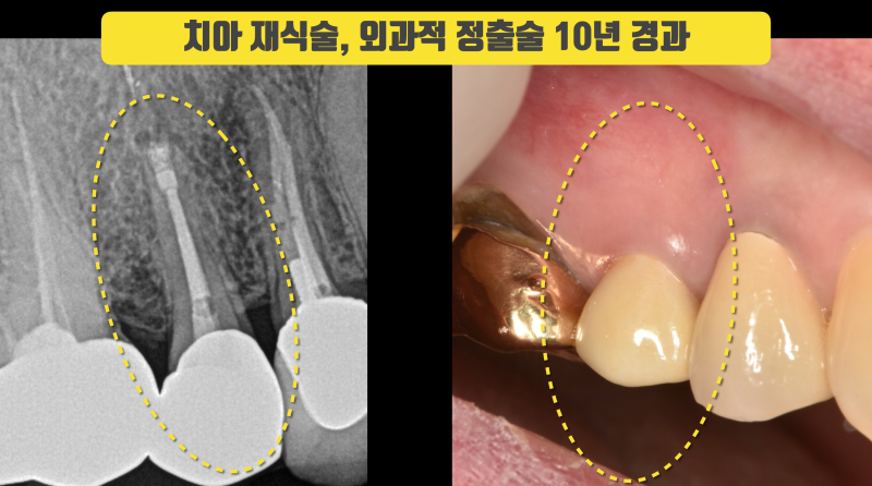 치아 재식술, 외과적 정출술 10년 경과 증례 #치아재식술 #의도적재식술