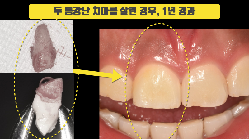 뿌리가 부러진 치아의 치아재식술 1년 경과 #치아재식술 #의도적재식술