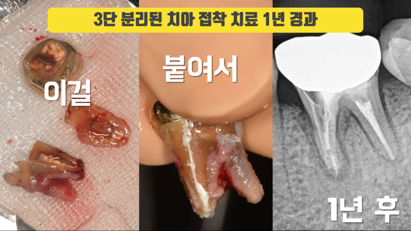 정신 나간 치아 살리기를 하는 이유 #치아재식술 #의도적재식술 #파절치아살리기