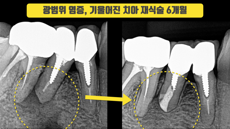 빼기도 힘든 치아를 재식술로 살린 경우