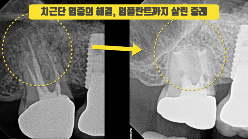치아도 살리고 임플란트까지 살린 증례 #재식술 #치아살리기