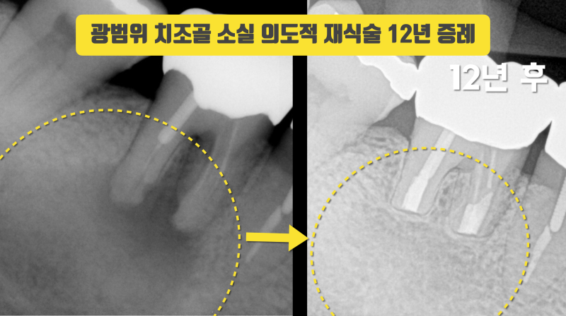 의도적 재식술(치아 재식술) 12년 경과 증례