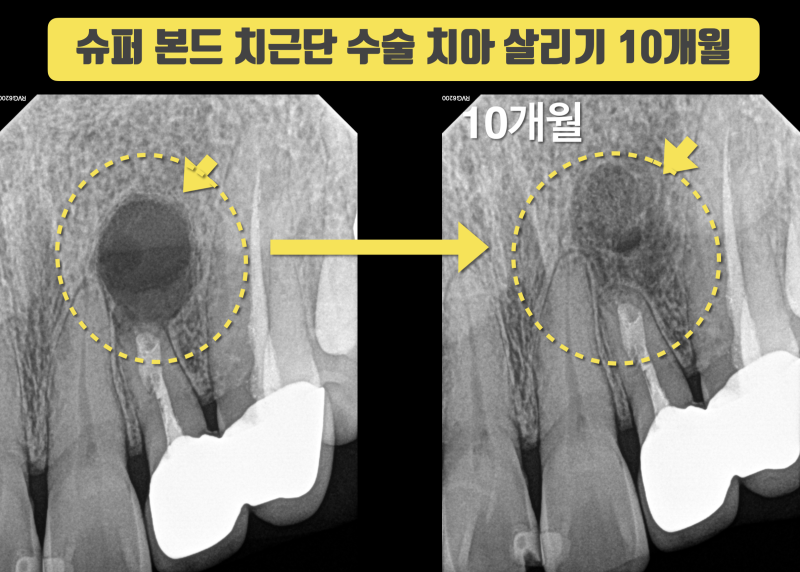 대충하면 반드시 재발하는 치근 절제술, 치근단 수술