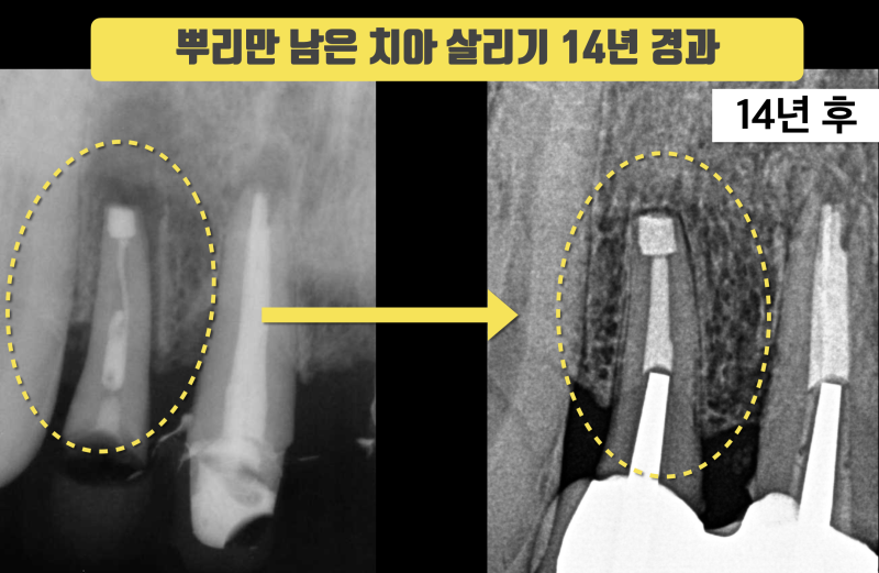 뿌리만 남은 치아 재식술 후14년 경과