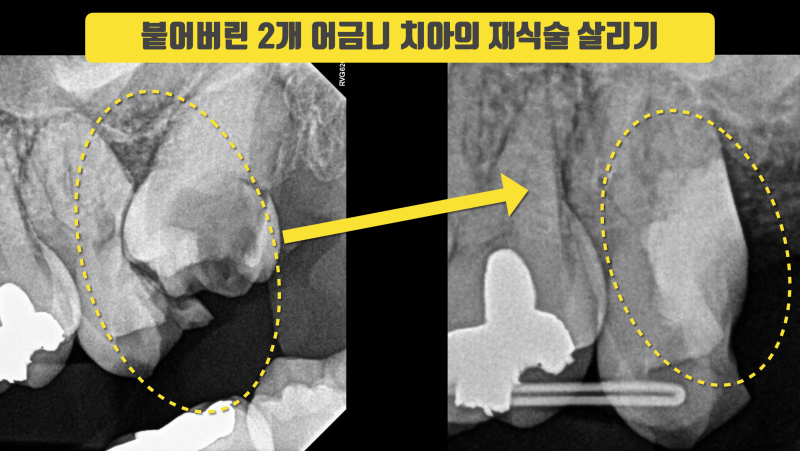 분당 서울대병원에서의 마지막 재식술 환자 #재식술 #치아재식술 #의도적재식술