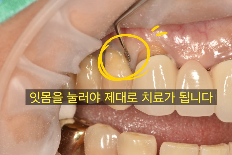 치경부 레진 치료 소개 #치경부레진 #최용훈원장