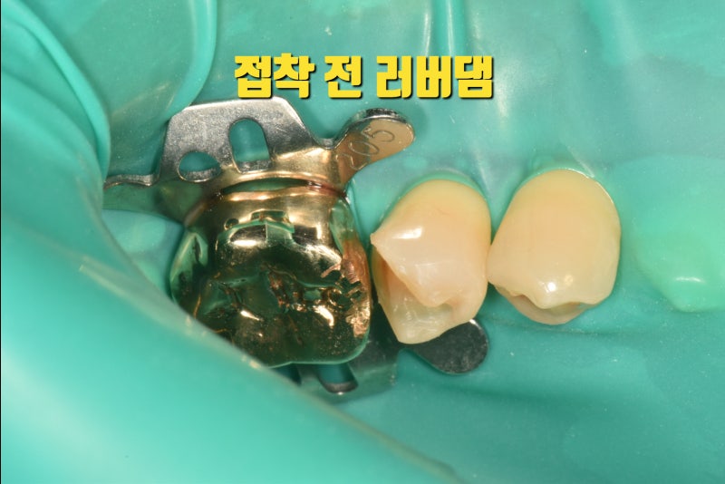 개원 후 첫 부분 세라믹 치료를 마치고...