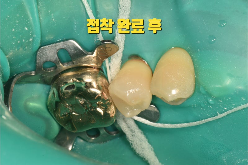 개원 후 첫 부분 세라믹 치료를 마치고...