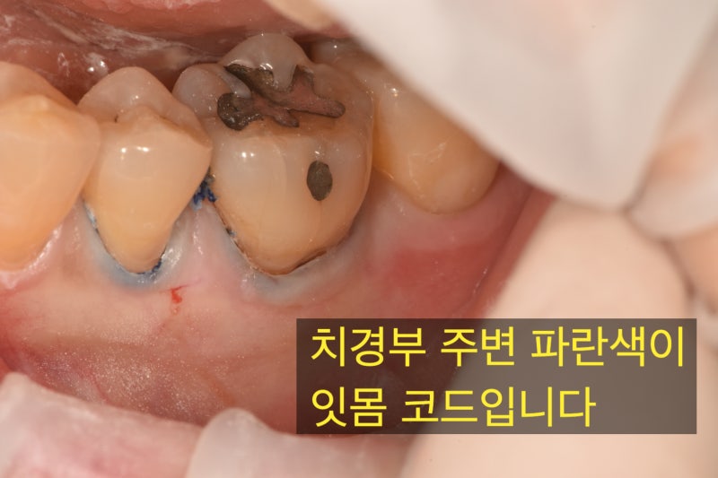 치경부 레진은 반드시 마취하고 코드 넣고 해야 합니다