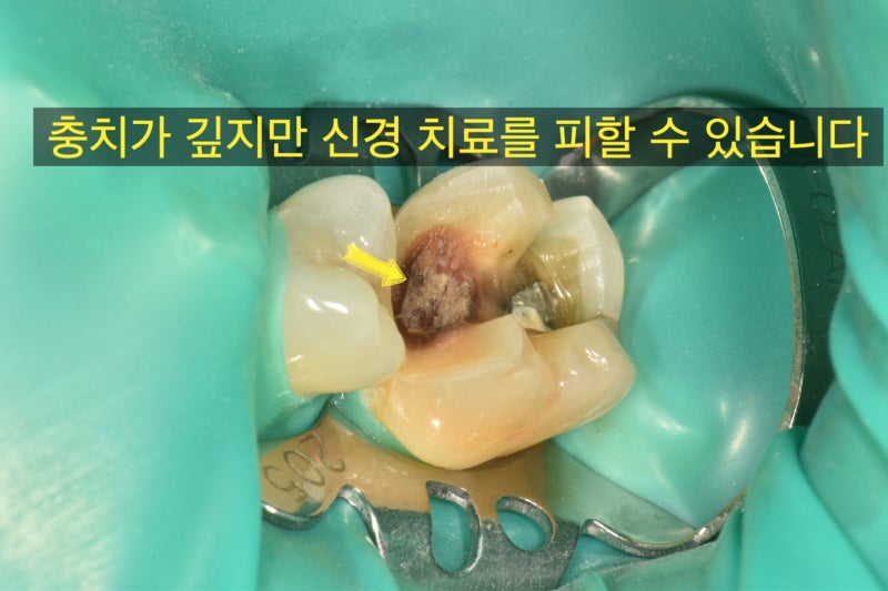 신경 치료를 안하는게 더 어렵습니다