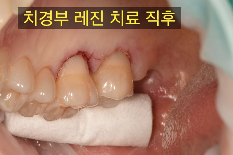 초 고난이도 치경부 마모증 치료 증례 사진 2