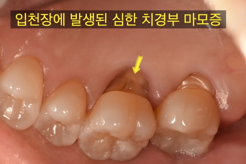 초 고난이도 치경부 마모증 치료 증례