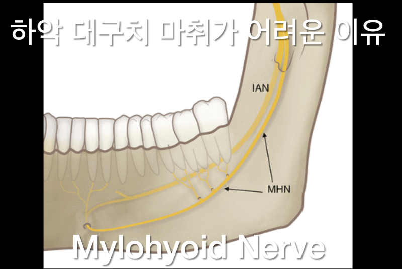 치과 마취가 안되는 이유