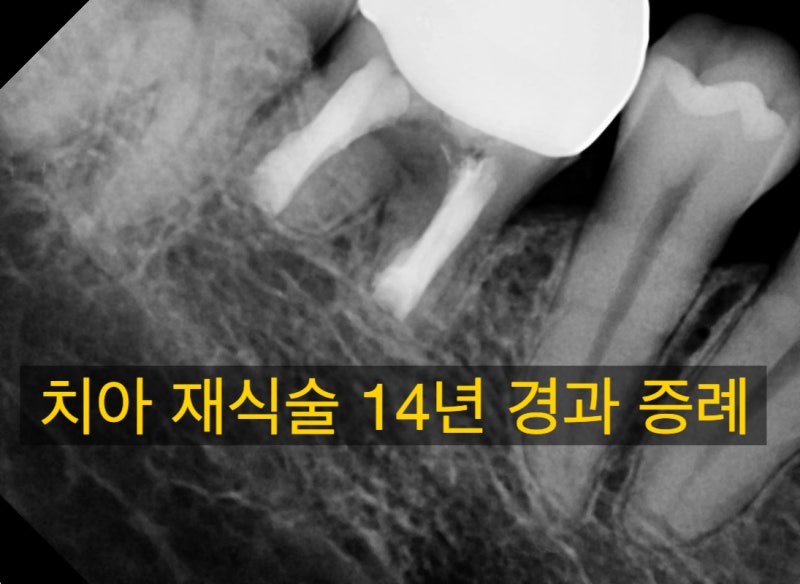 14년 전에 했던 치아 재식술 성공 증례 #치아재식술 #의도적재식술