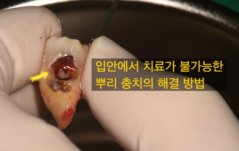 깊은 뿌리 충치의 가장 효과적인 해결 방법 치아재식술