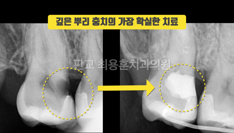 깊은 뿌리 충치의 가장 효과적인 해결 방법 치아재식술