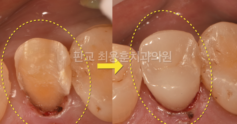 무조건 치아를 깍지 말라는 환자 사진 2