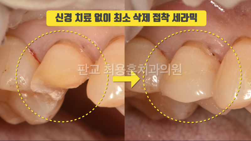 무조건 치아를 깍지 말라는 환자
