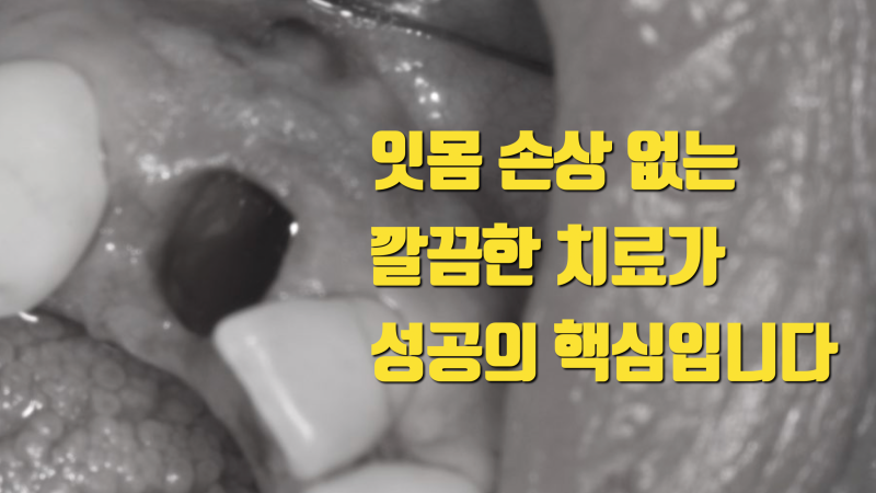 깔끔한 발치는 치아재식술 성공의 기본 #치아재식술 #의도적재식술