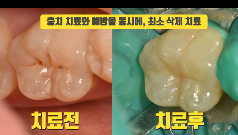 초기 충치, 이 방법 추천하는 이유