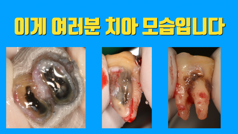치아 살리기가 어려운 현실적인 문제 #재식술 #치아재식술 #의도적재식술