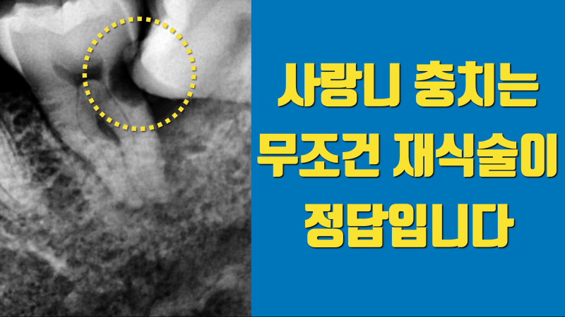 사랑니 충치는 재식술이 제일 낫습니다 치아재식술