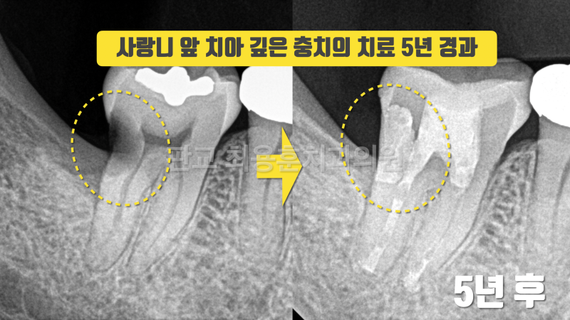사랑니 앞치아 깊은 충치의 재식술 치료 5년 증례 치아재식술 #의도적재식술 #치아재식술 사진 2