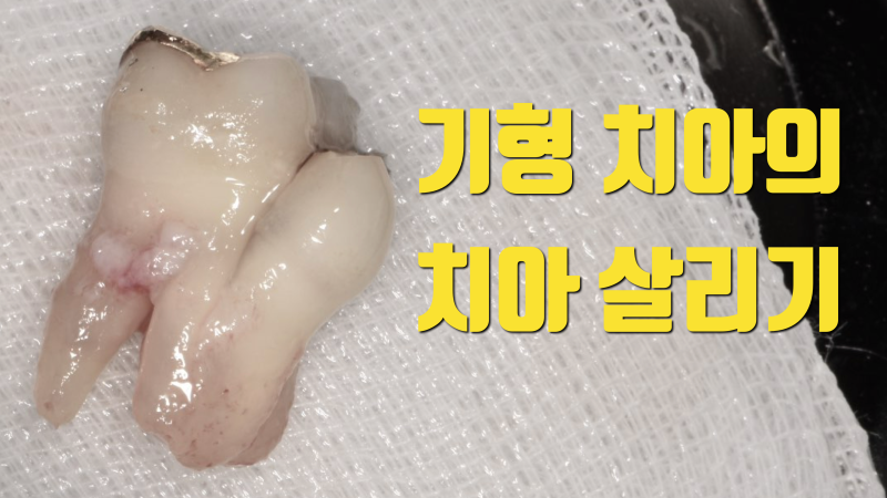 [임상 노트]기형 치아의 재식술 치아 살리기 치아재식술